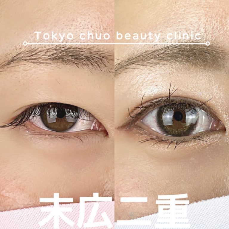 二重埋没法(担当医:TCB 医師)の症例写真1