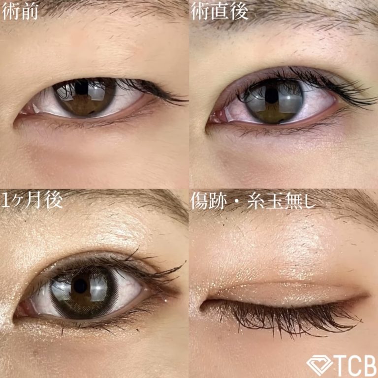 二重埋没法(担当医:TCB 医師)の症例写真2