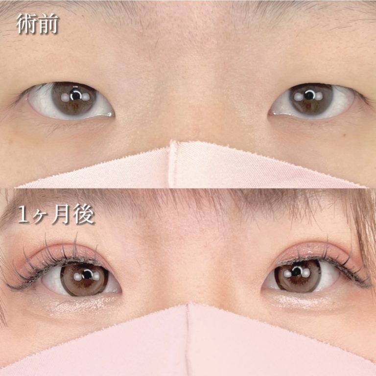 二重埋没法(担当医:TCB 医師)の症例写真1