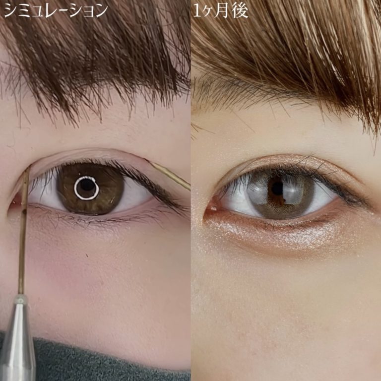 二重埋没法(担当医:TCB 医師)の症例写真2