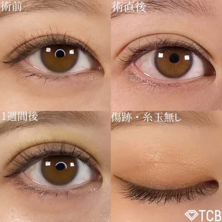 二重埋没法(担当医:TCB 医師)の症例写真2