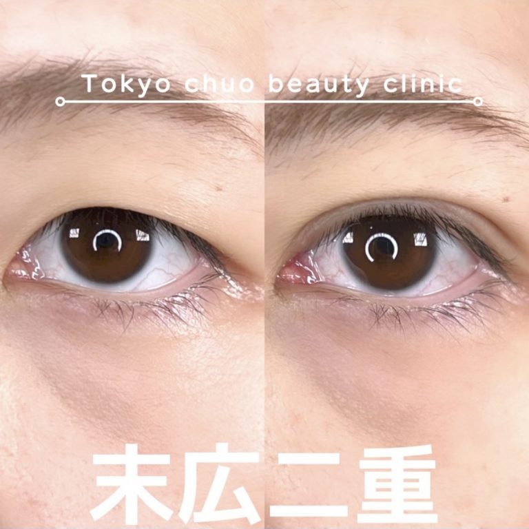 二重埋没法(担当医:TCB 医師)の症例写真1