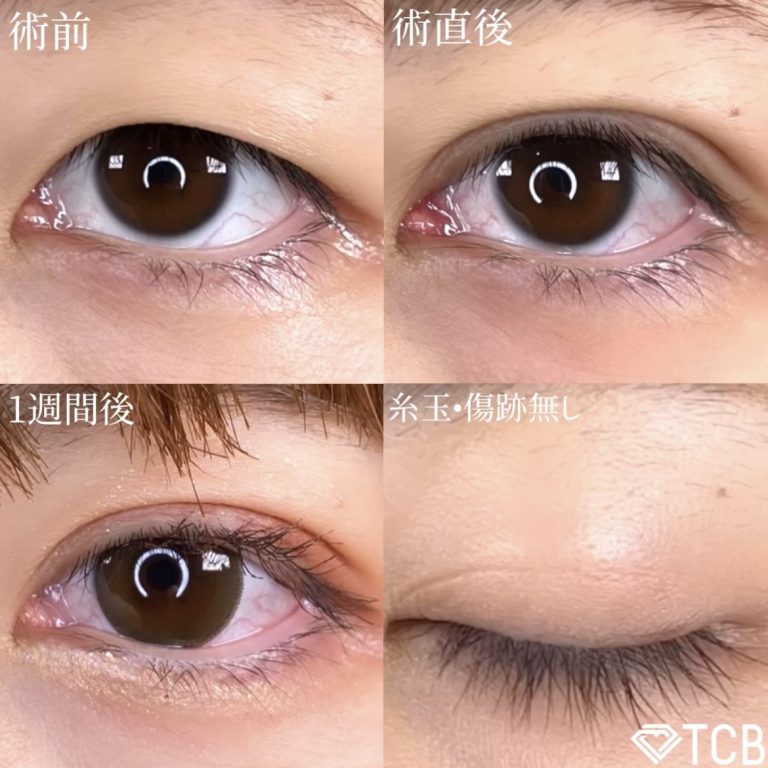 二重埋没法(担当医:TCB 医師)の症例写真2