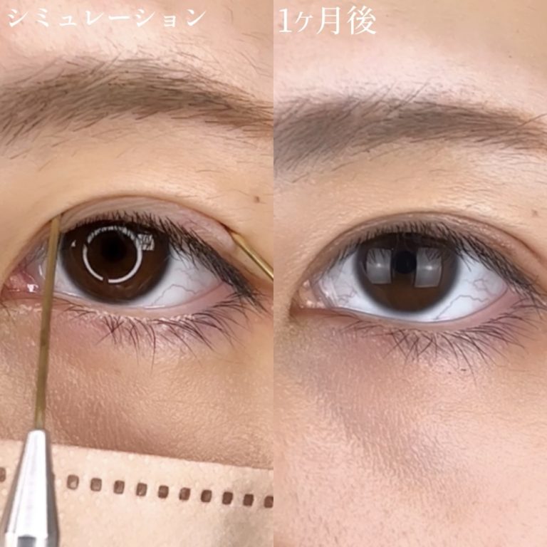 二重埋没法(担当医:TCB 医師)の症例写真3