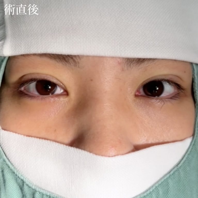 二重埋没法(担当医:TCB 医師)の症例写真4