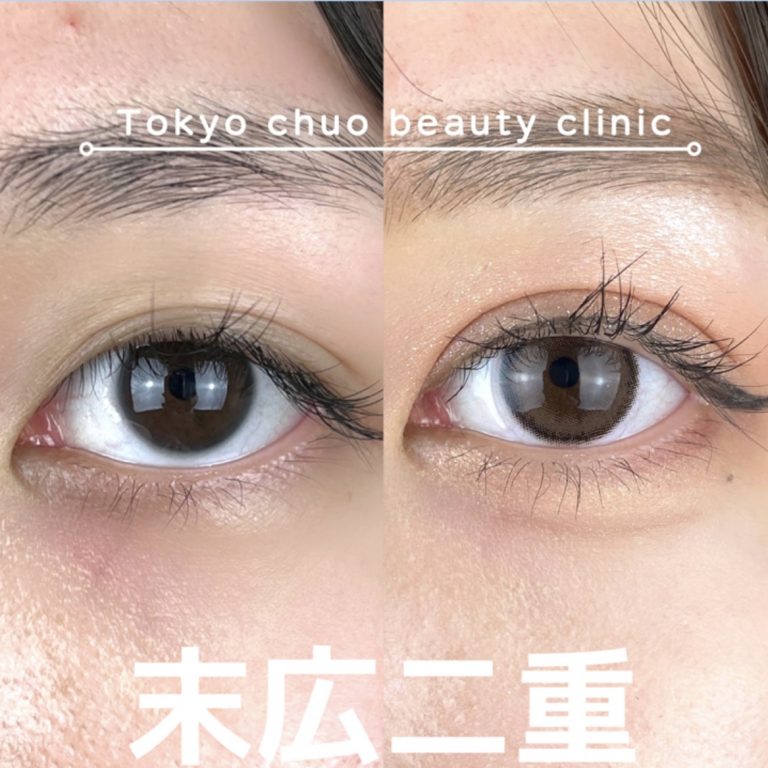二重埋没法(担当医:TCB 医師)の症例写真1