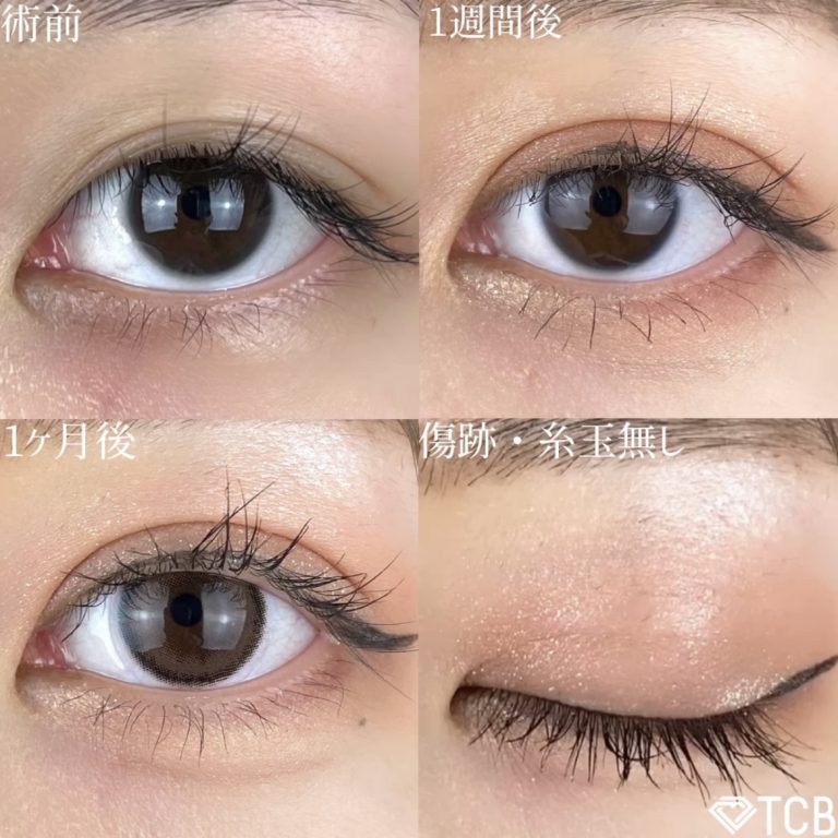 二重埋没法(担当医:TCB 医師)の症例写真2