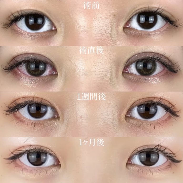 二重埋没法(担当医:TCB 医師)の症例写真3