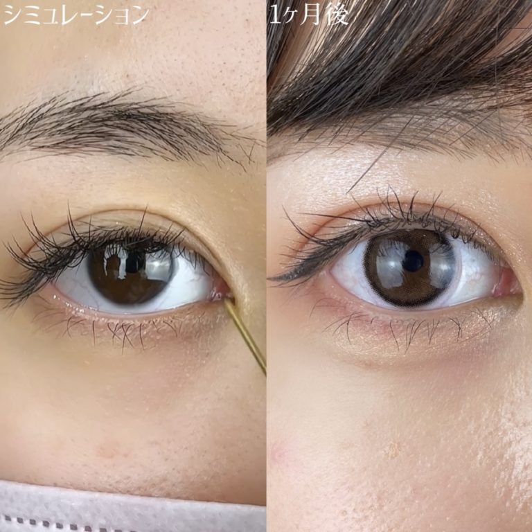 二重埋没法(担当医:TCB 医師)の症例写真4