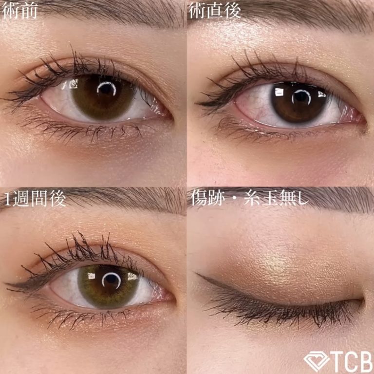 二重埋没法(担当医:TCB 医師)の症例写真1