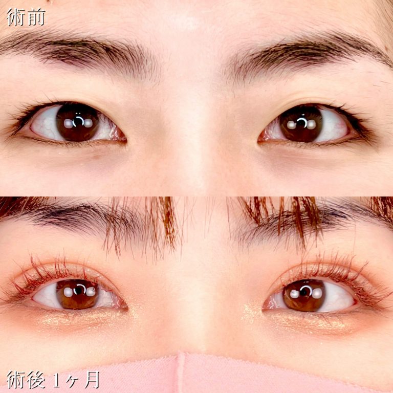 二重埋没法(担当医:TCB 医師)の症例写真1