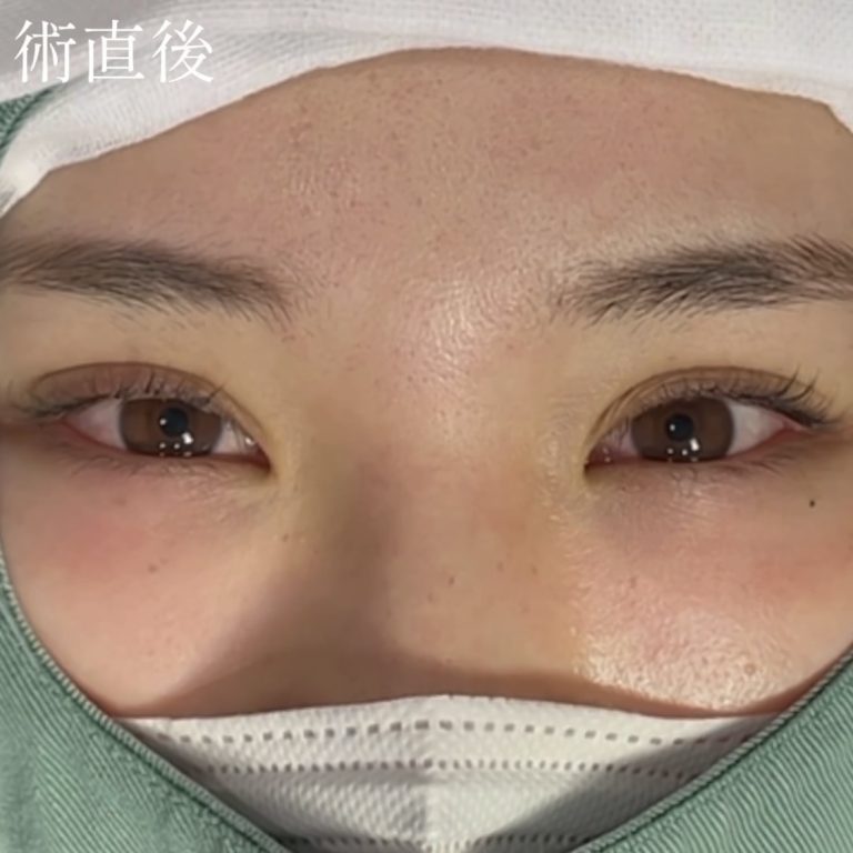 二重埋没法(担当医:TCB 医師)の症例写真4