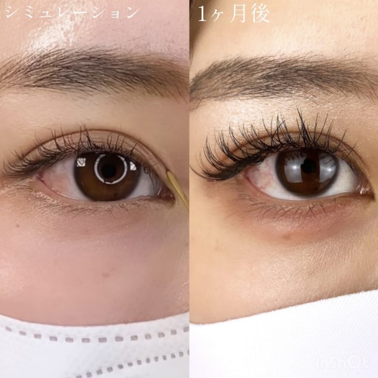 二重埋没法(担当医:TCB 医師)の症例写真3