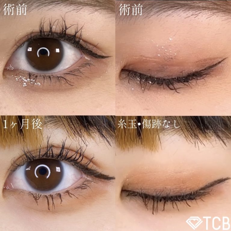 二重埋没法(担当医:TCB 医師)の症例写真1