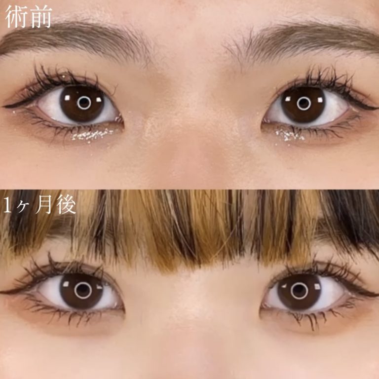 二重埋没法(担当医:TCB 医師)の症例写真2
