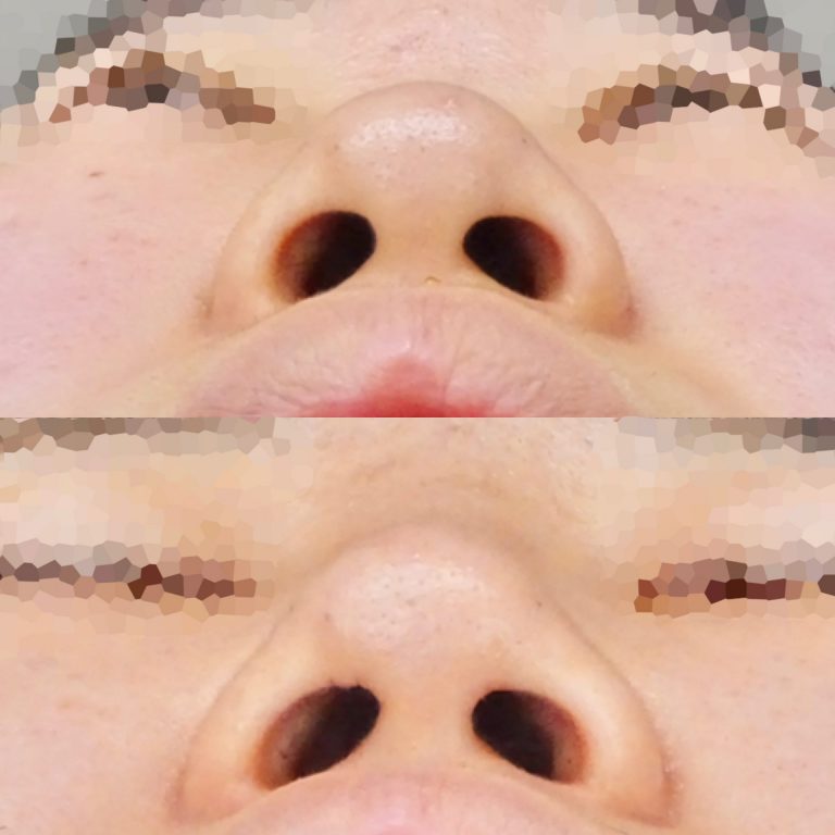 鼻プロテーゼ（隆鼻術）(担当医:佐藤 麻未 医師)の症例写真3