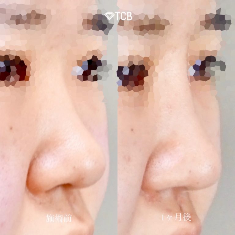 鼻プロテーゼ（隆鼻術）(担当医:佐藤 麻未 医師)の症例写真4