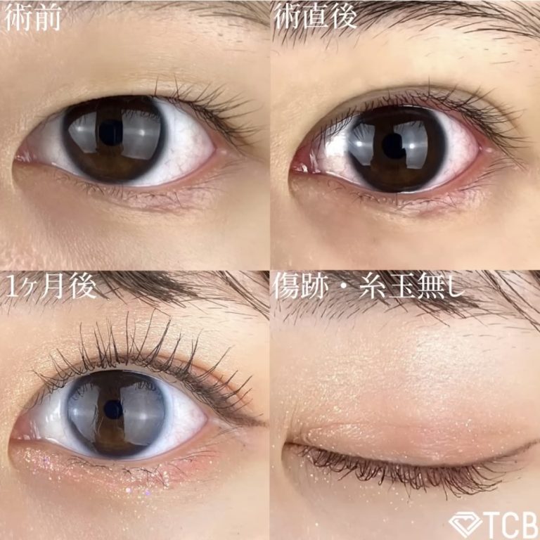 二重埋没法(担当医:TCB 医師)の症例写真2