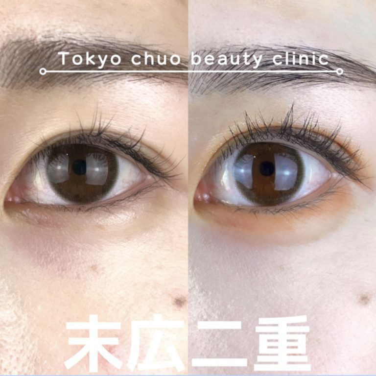 二重埋没法(担当医:TCB 医師)の症例写真1