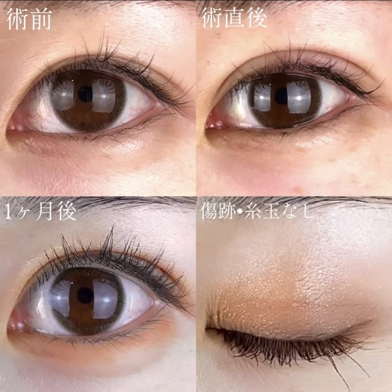 二重埋没法(担当医:TCB 医師)の症例写真1