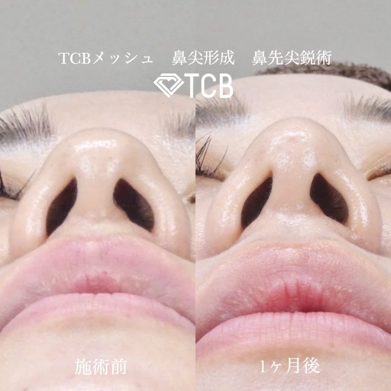 鼻尖形成(担当医:寺西 宏王 医師)の症例写真1