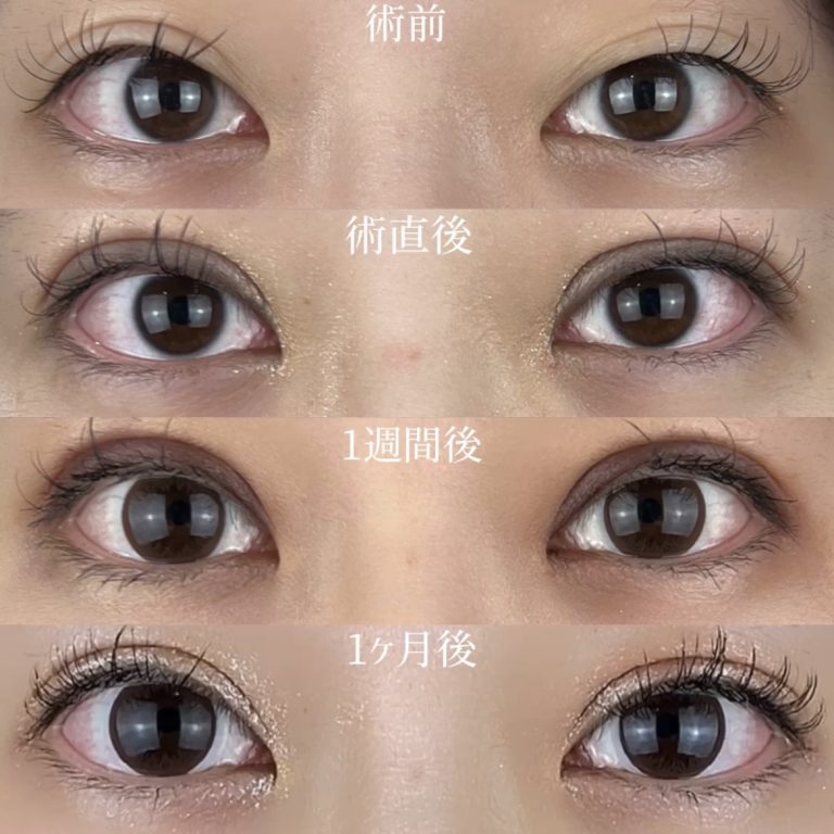 二重埋没法(担当医:TCB 医師)の症例写真3