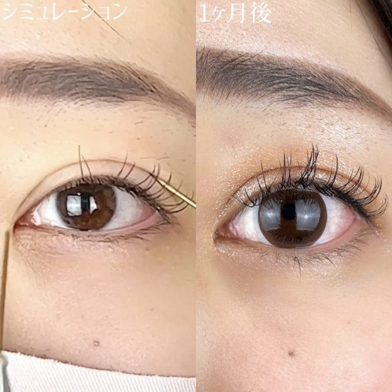 二重埋没法(担当医:TCB 医師)の症例写真4