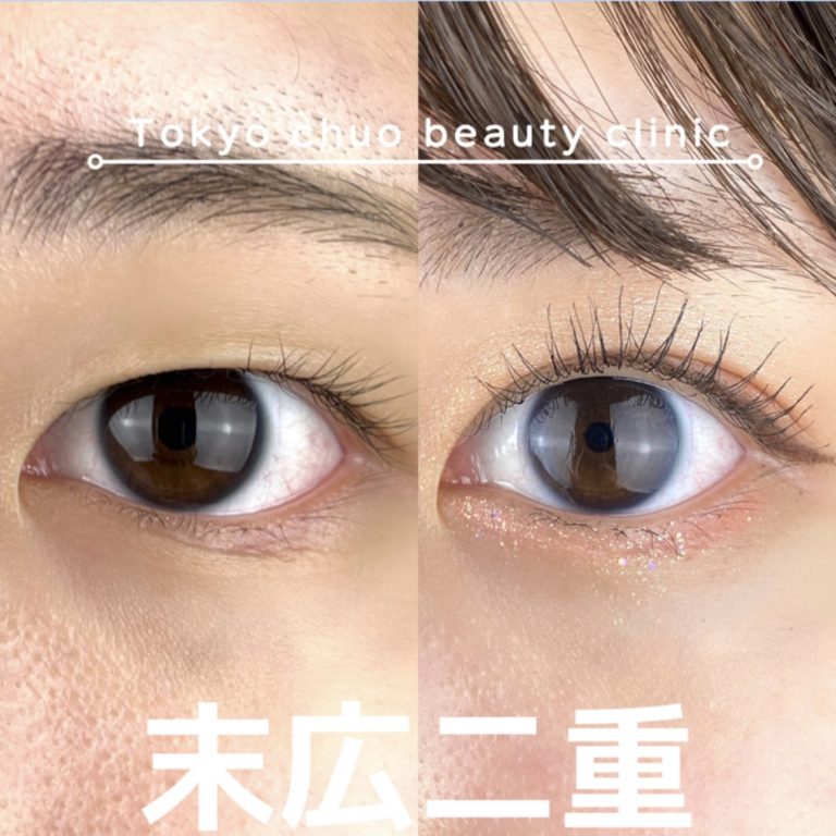 二重埋没法(担当医:TCB 医師)の症例写真1