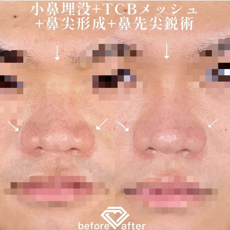 TCBメッシュ(担当医:TCB 医師)の症例写真1