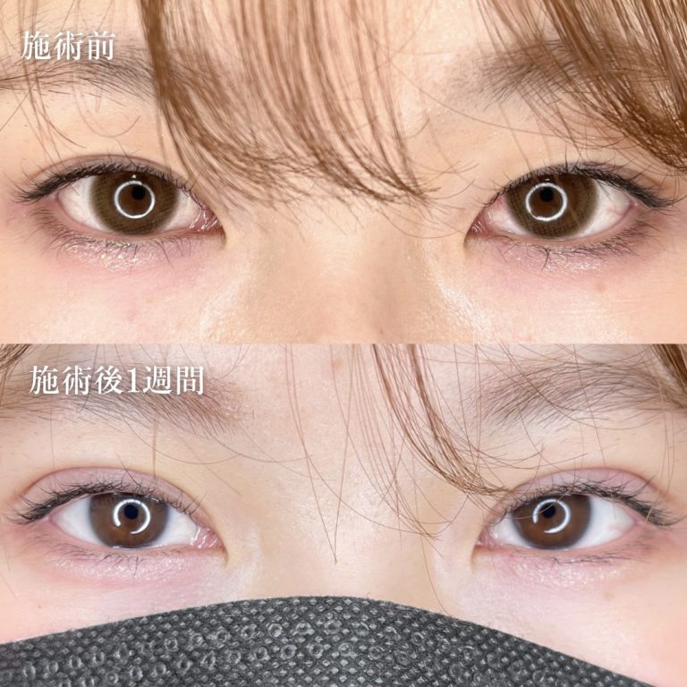 二重埋没法(担当医:TCB 医師)の症例写真1