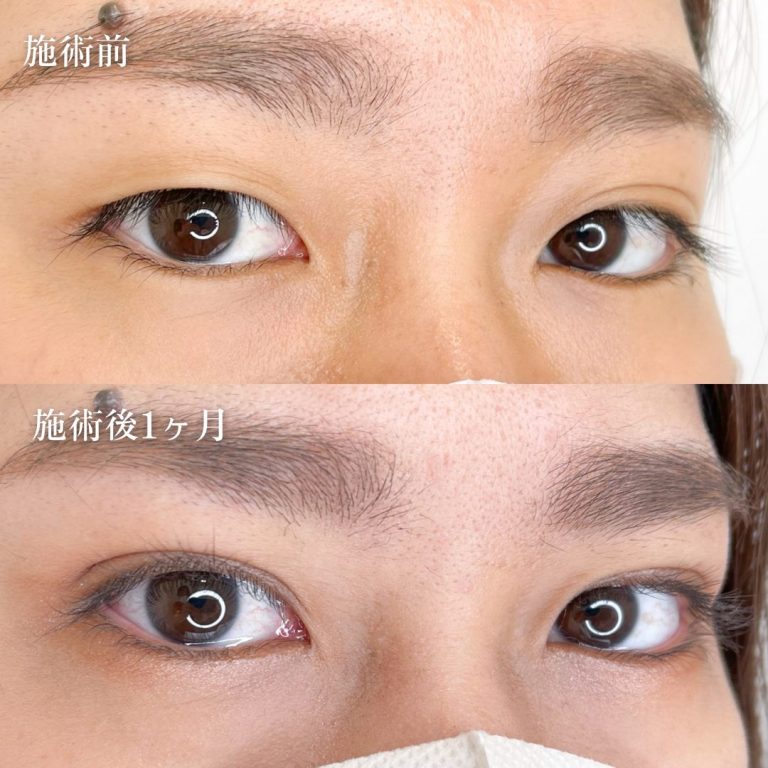 二重埋没法(担当医:TCB 医師)の症例写真1