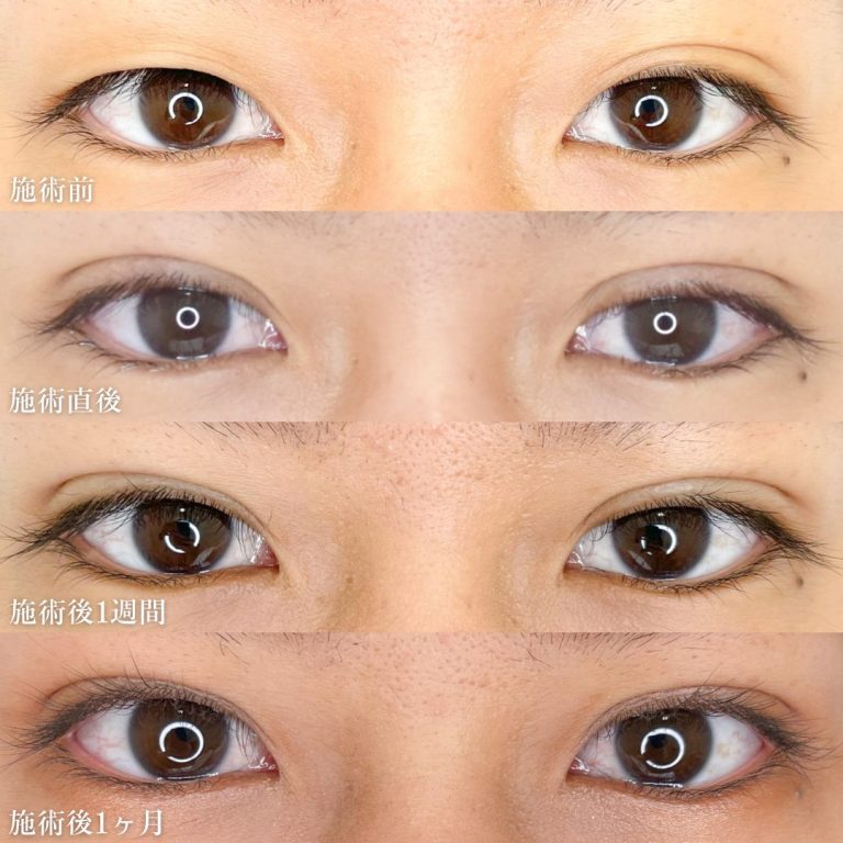 二重埋没法(担当医:TCB 医師)の症例写真2