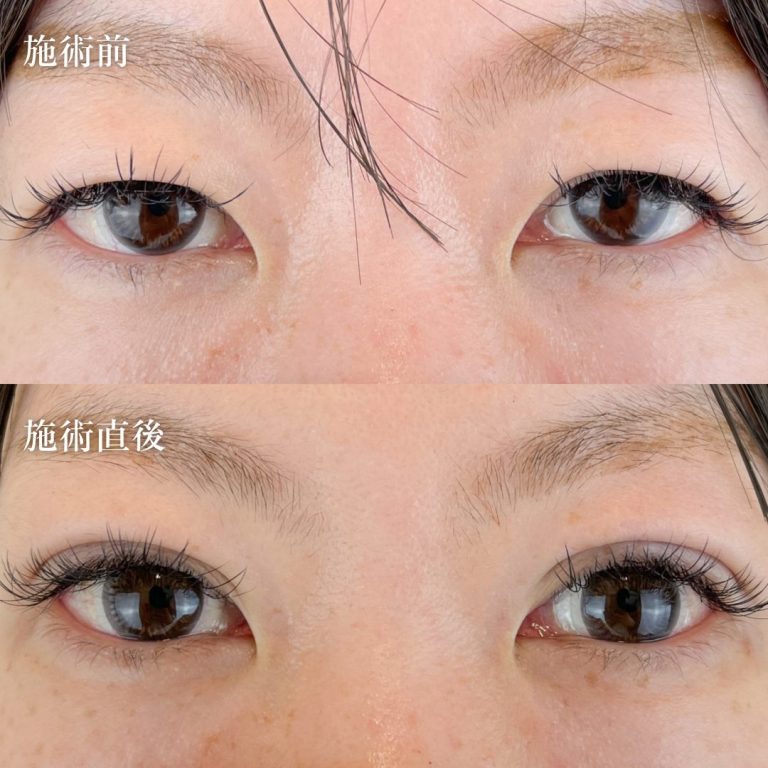 二重埋没法(担当医:TCB 医師)の症例写真1