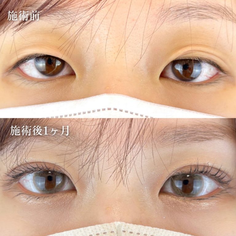 二重埋没法(担当医:TCB 医師)の症例写真2
