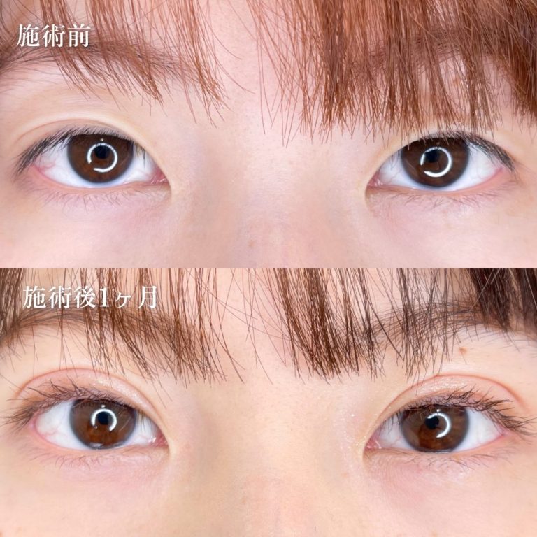 二重埋没法(担当医:TCB 医師)の症例写真1