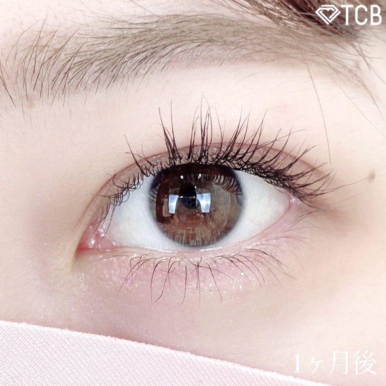 二重埋没法(担当医:TCB 医師)の症例写真1
