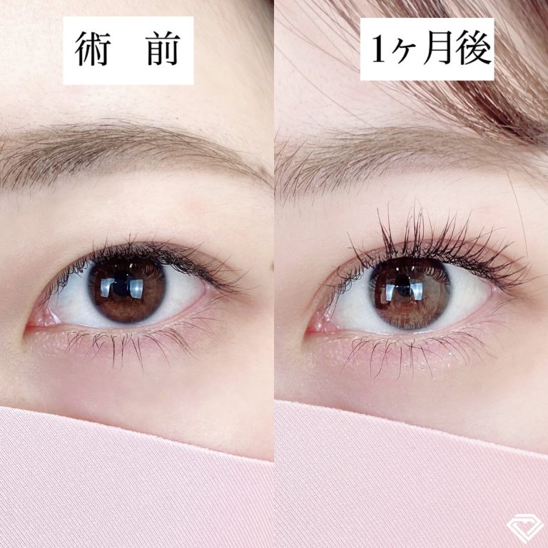 二重埋没法(担当医:TCB 医師)の症例写真2