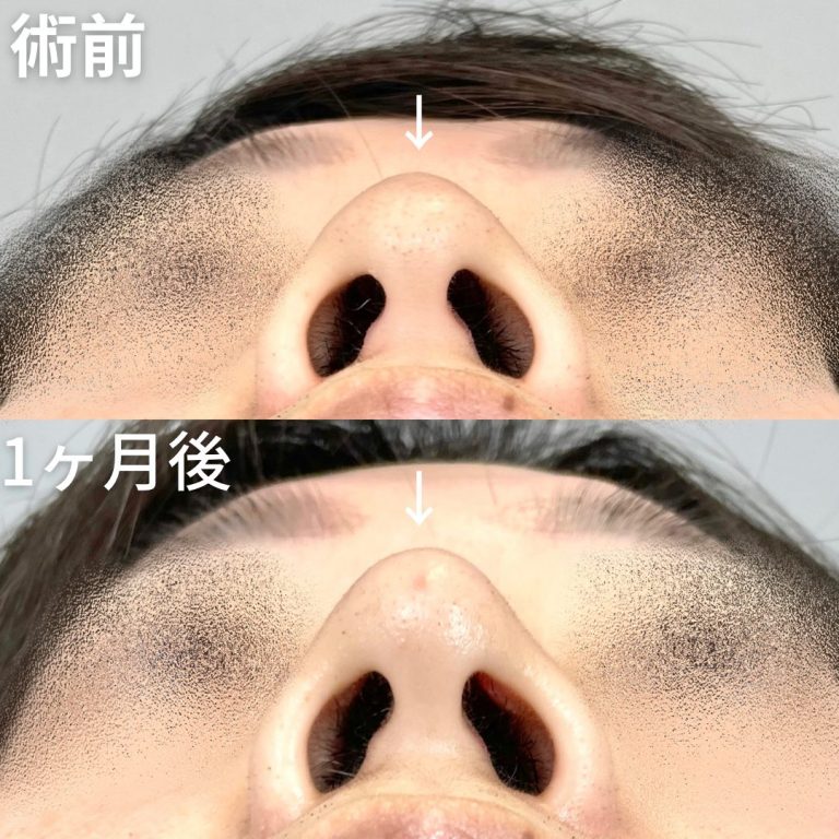 鼻尖形成(担当医:山内 崇史 医師)の症例写真2