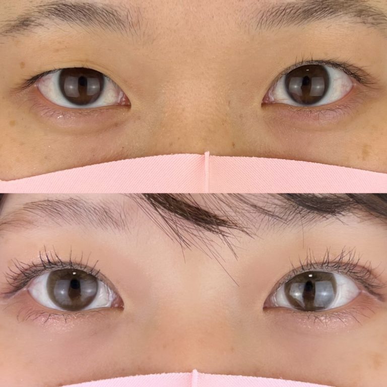 二重埋没法(担当医:TCB 医師)の症例写真1