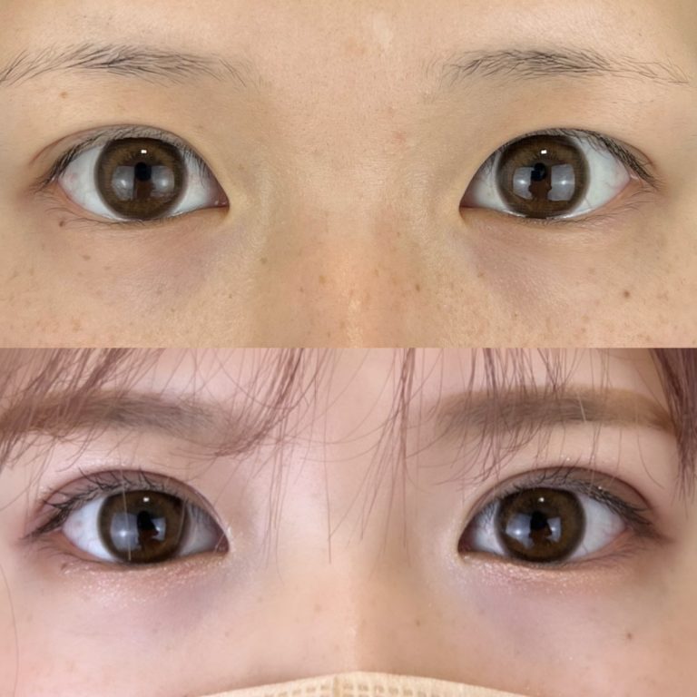 二重埋没法(担当医:TCB 医師)の症例写真1