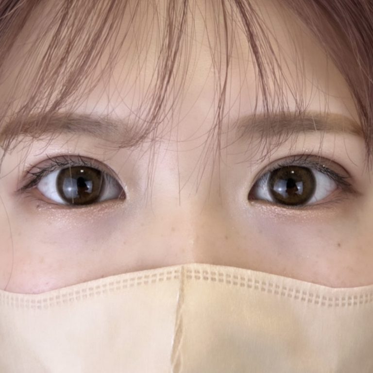 二重埋没法(担当医:TCB 医師)の症例写真2