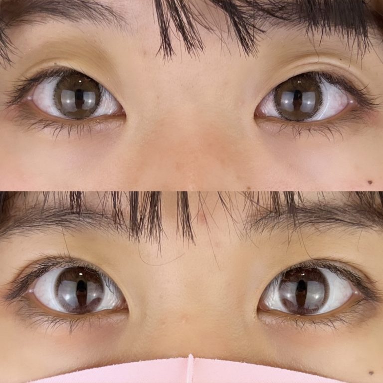 二重埋没法(担当医:TCB 医師)の症例写真1