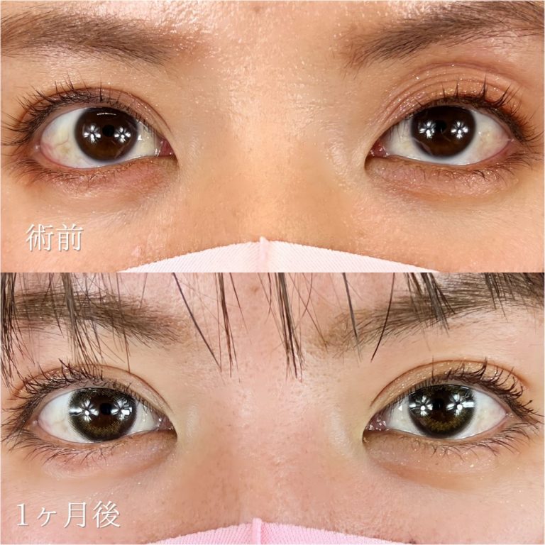 二重埋没法(担当医:TCB 医師)の症例写真1