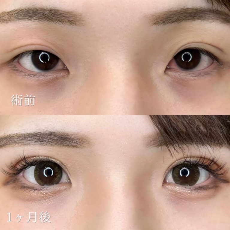 二重埋没法(担当医:TCB 医師)の症例写真1