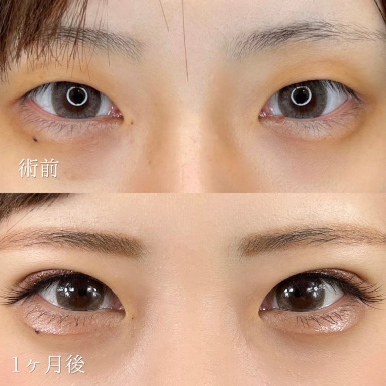 二重埋没法(担当医:TCB 医師)の症例写真1