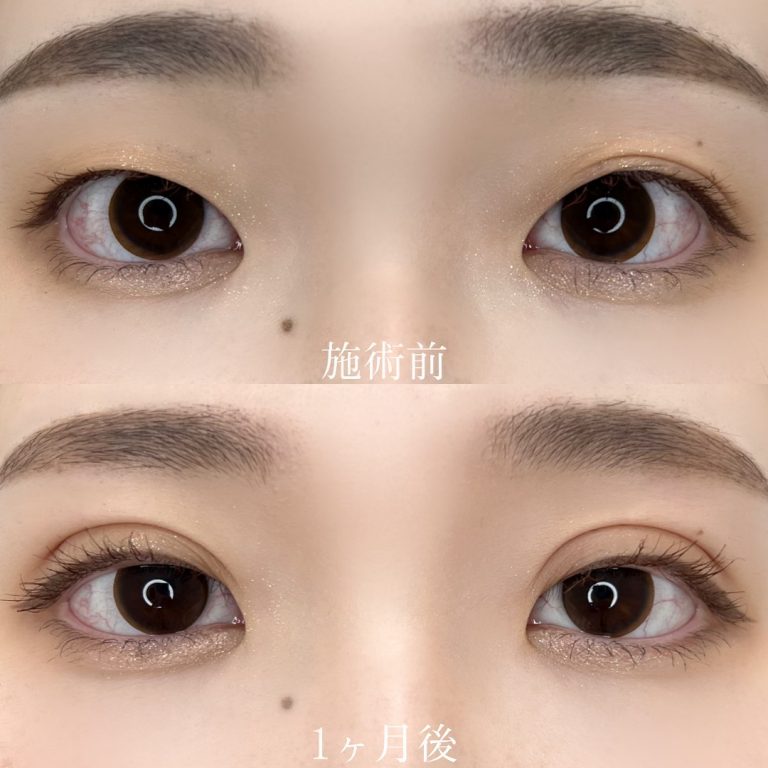 二重埋没法(担当医:TCB 医師)の症例写真1