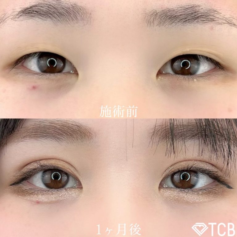 二重埋没法(担当医:TCB 医師)の症例写真1