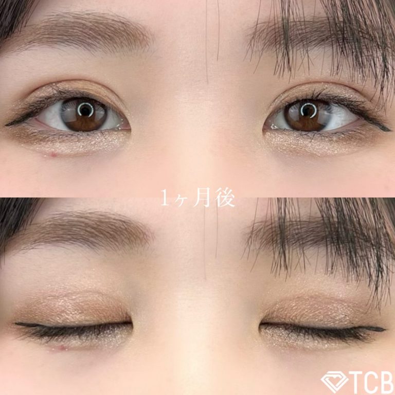 二重埋没法(担当医:TCB 医師)の症例写真2