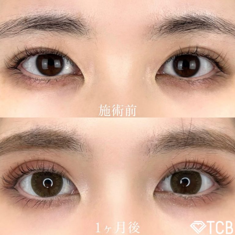 二重埋没法(担当医:TCB 医師)の症例写真1