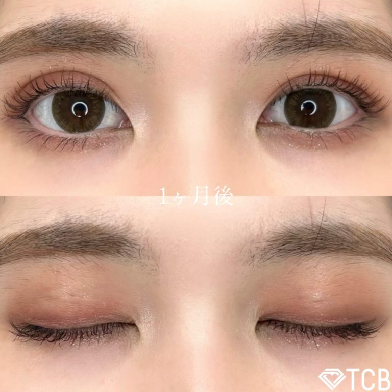 二重埋没法(担当医:TCB 医師)の症例写真2